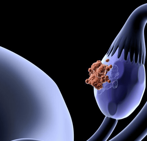 Fallopian Tube Cancer Fallopian Tube Cancer