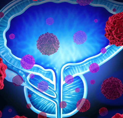 Metastatic Prostate Cancer: All You Need to Know Metastatic Prostate Cancer: All You Need to Know