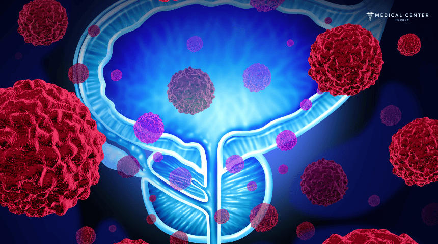 Metastatic Prostate Cancer: All You Need to Know