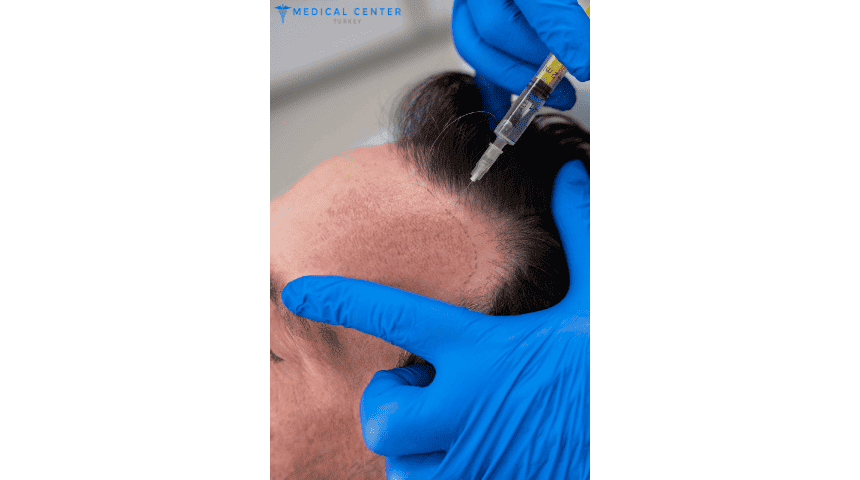 PRP For Hair Loss