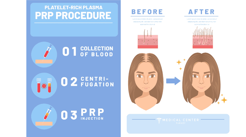 PRP For Hair Loss