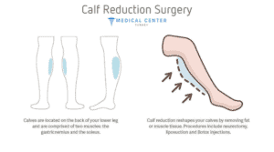 Calf reduction: pros and cons of selective neurectomy