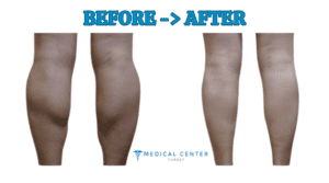 Calf reduction