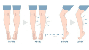 Calf reduction: pros and cons of selective neurectomy