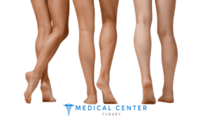 Calf reduction