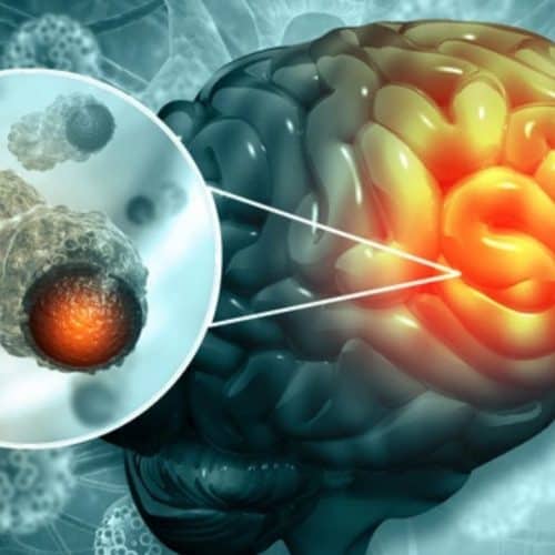 Brain Cancer Treatment in Turkey Brain Cancer Treatment in Turkey