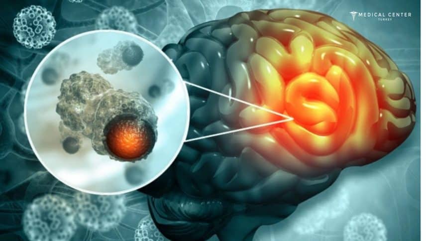 Brain Cancer Treatment in Turkey Brain Cancer Treatment in Turkey