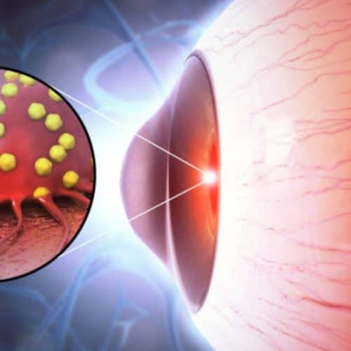 Eye Cancer Eye Cancer
