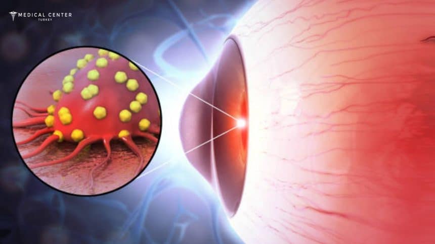 Eye Cancer