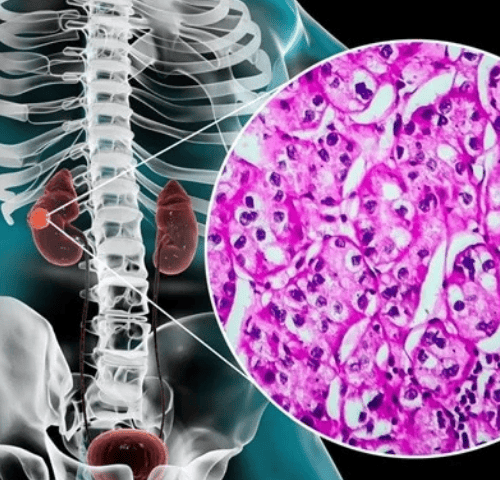 Kidney (Renal Cell) Cancer Kidney (Renal Cell) Cancer
