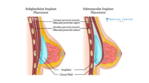Breast Augmentation Pros and Cons