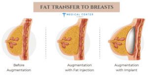 Breast Augmentation Pros and Cons
