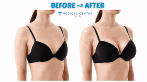 Breast Augmentation Pros and Cons: Implants vs fat Transfer