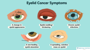 eye lid cancer