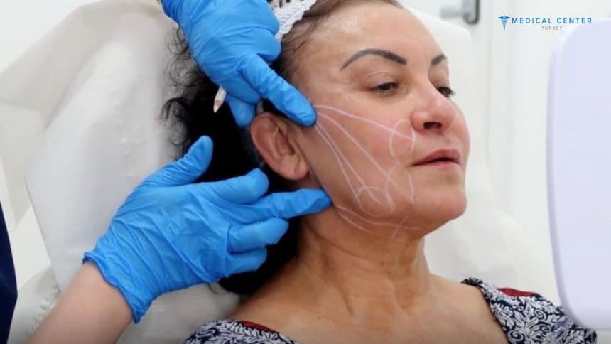 Facelift Cost in Turkey