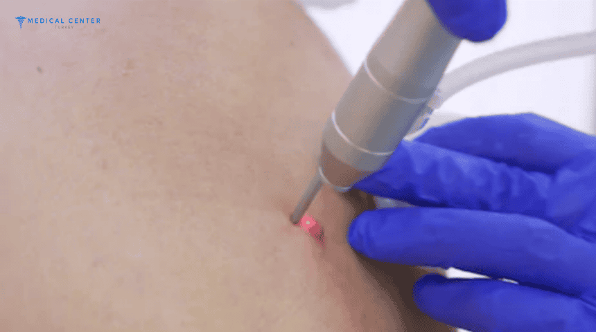 What is the cost of mole removal in Turkey? What is the cost of mole removal in Turkey?