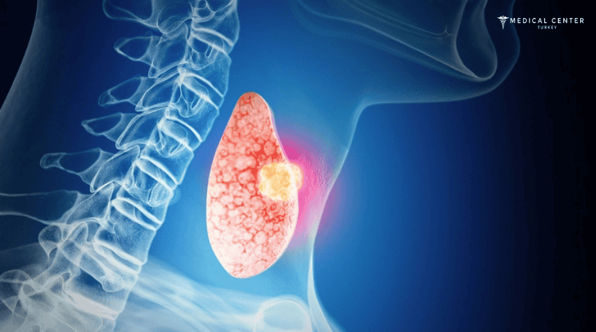Thyroid Cancer