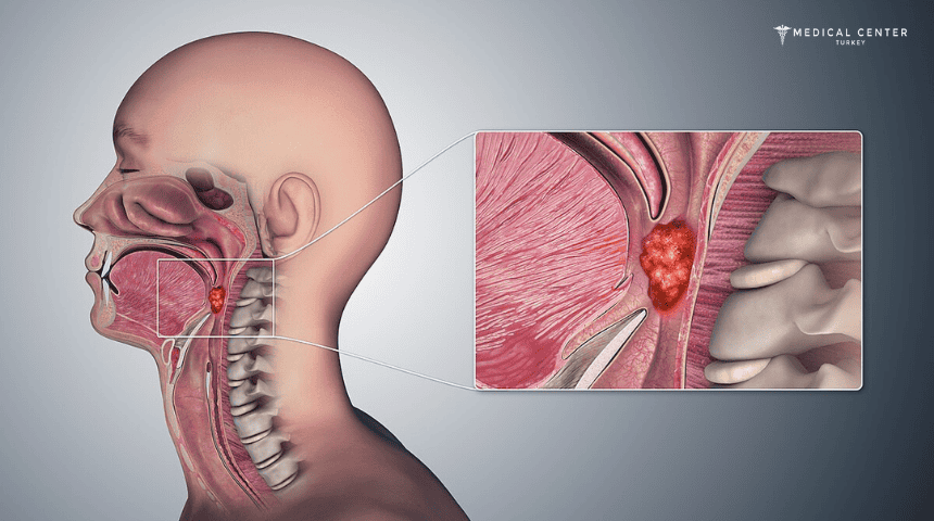 Throat Cancer Throat Cancer