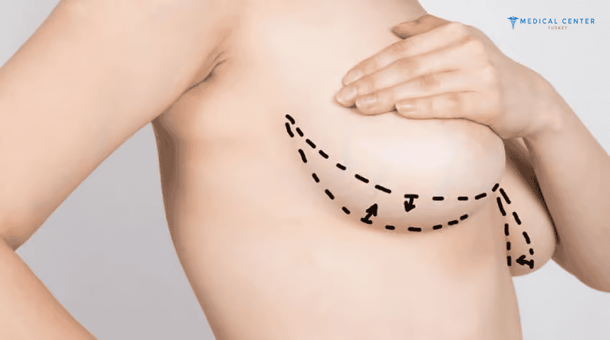 Breast Lift Cost in Turkey