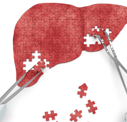 Removal of Liver Cancer Removal of Liver Cancer