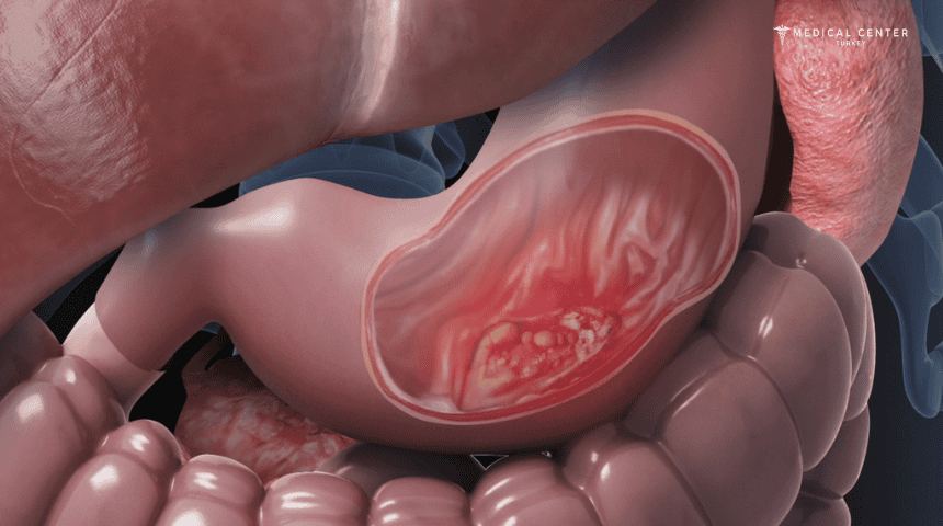 Stomach (Gastric) Cancer