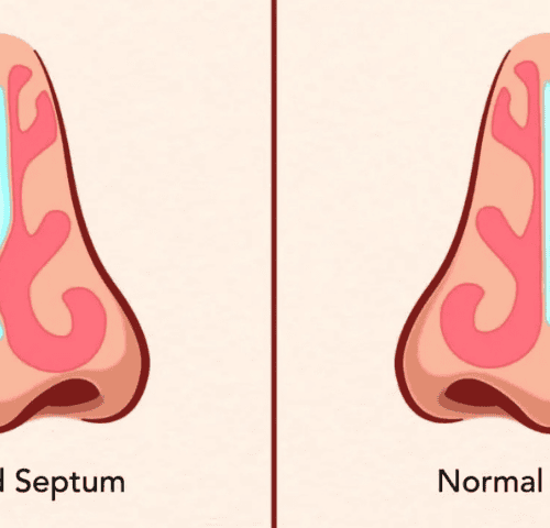 Septoplasty Cost in Turkey