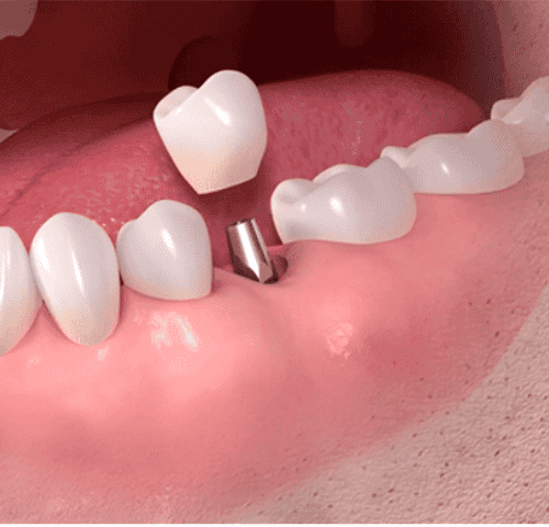Dental Implants in Turkey: Types, Prices, Procedures