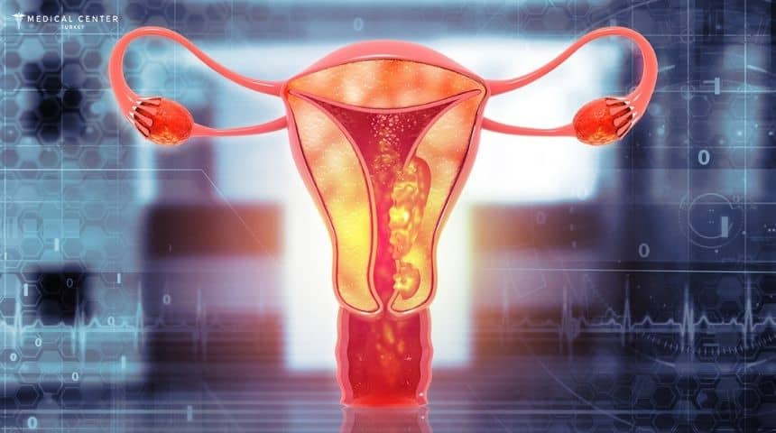 Uterine Cancer in Turkey Uterine Cancer in Turkey
