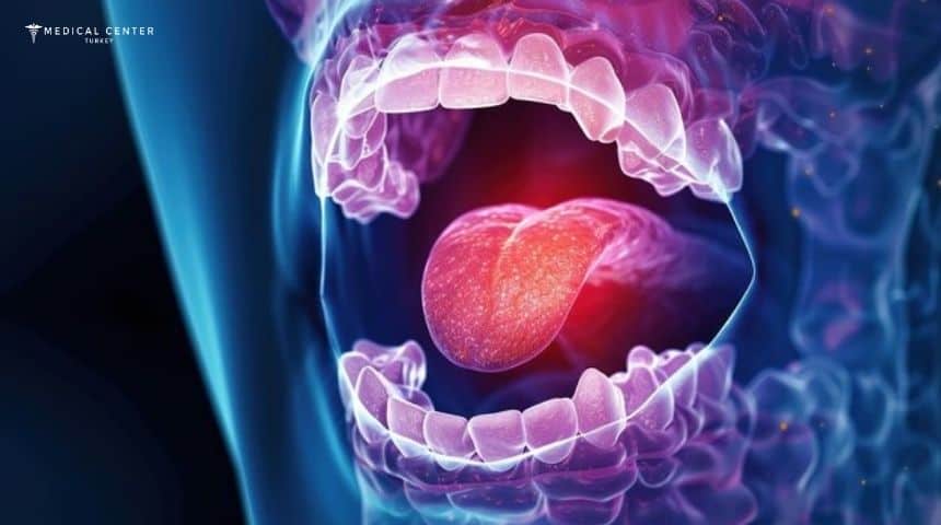 Tongue Cancer in Turkey