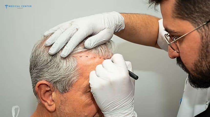 Best Hair Transplant Turkey