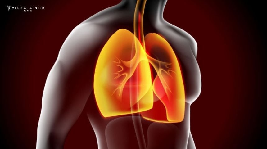 Lung Cancer Stage 4 in Turkey