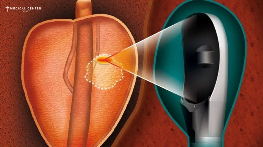 HIFU for Prostate Cancer in Turkey