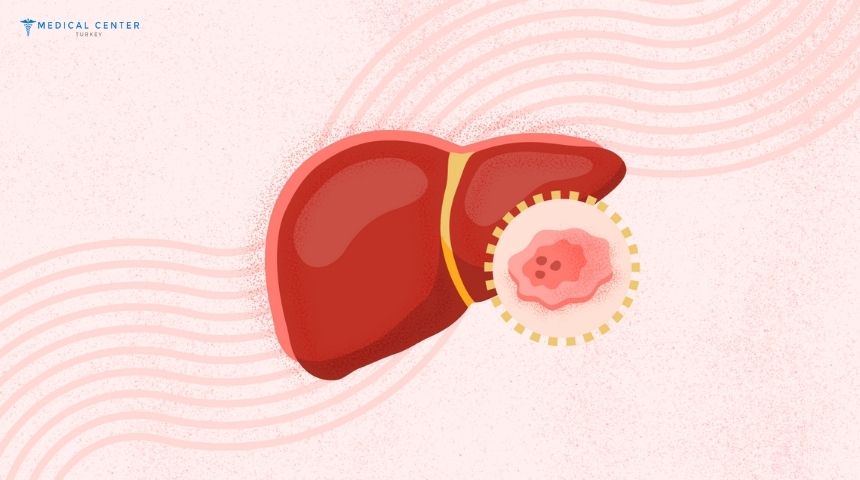 Liver Cancer Stage 3 Liver Cancer Stage 3