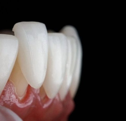 Advantages and Disadvantages of Veneers