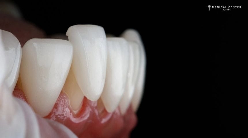 Advantages and Disadvantages of Veneers