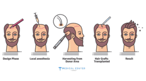 Hair Transplant in Turkey: Best Doctors 