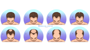 Does Hair Transplant Hurt?