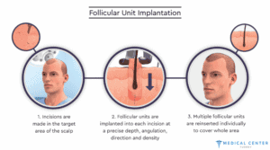 The Patient Journey in Hair Transplantation