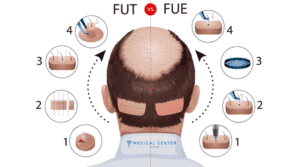 Does Hair Transplant Hurt