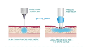 Does Hair Transplant Hurt