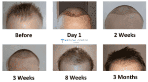 Does Hair Transplant Hurt