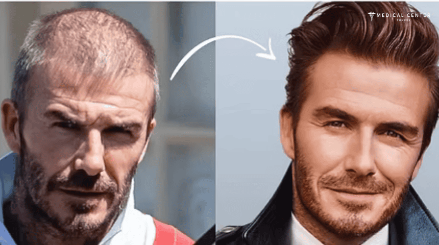 David Beckham’s Hair Transplantation