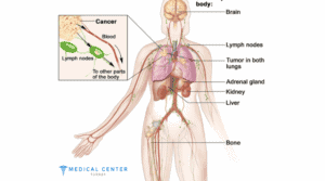 Chemotherapy for Liver Cancer