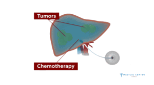 Chemotherapy for Liver Cancer