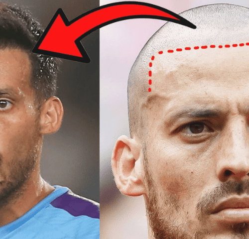 David Silva’s Hair Transplantation
