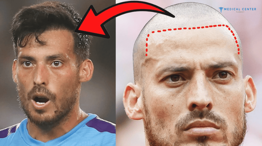 David Silva’s Hair Transplantation David Silva’s Hair Transplantation