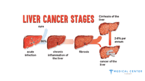 Chemotherapy fo Liver Cancer