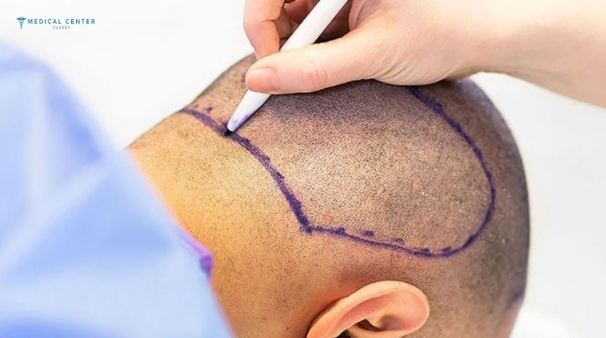 How Long Does It Take To See Results From Hair Transplant Surgery?