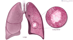 CHEMOTHERAPY FOR LUNG CANCER