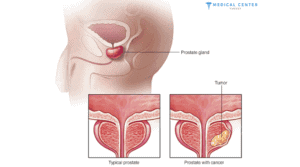Radiotherapy for Prostate Cancer